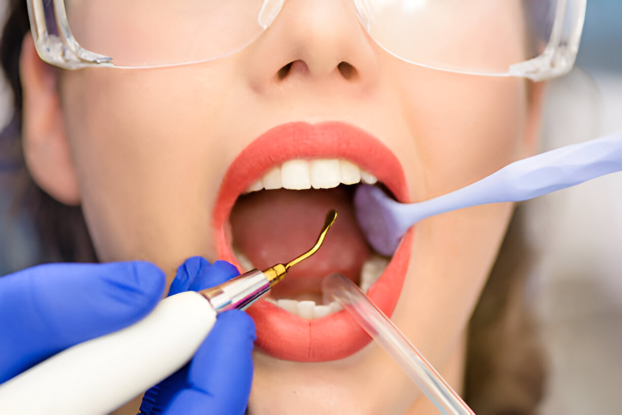 Root Canals: Essential Dental Care at the Dental Care Center of South Kansas City_2