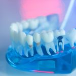 Root Canals: Essential Dental Care at the Dental Care Center of South Kansas City_FI