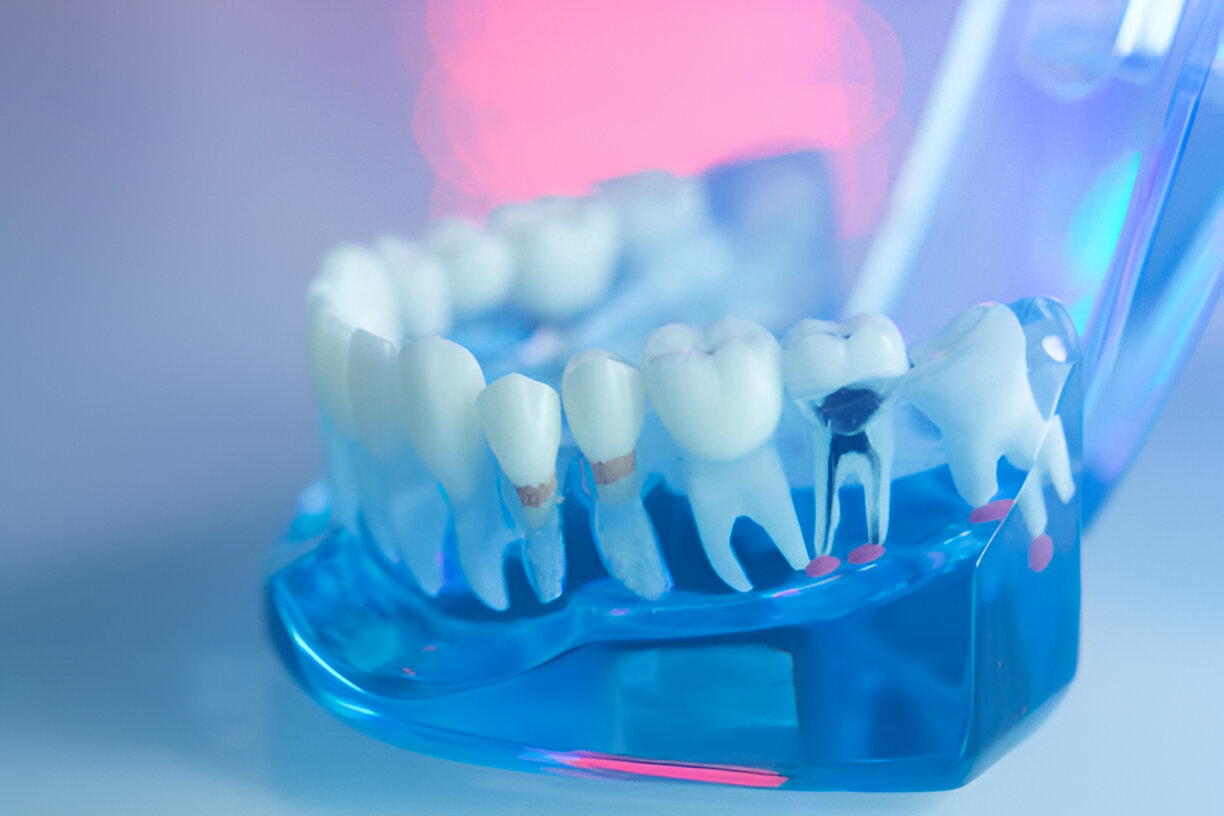 Root Canals: Essential Dental Care at the Dental Care Center of South Kansas City_FI