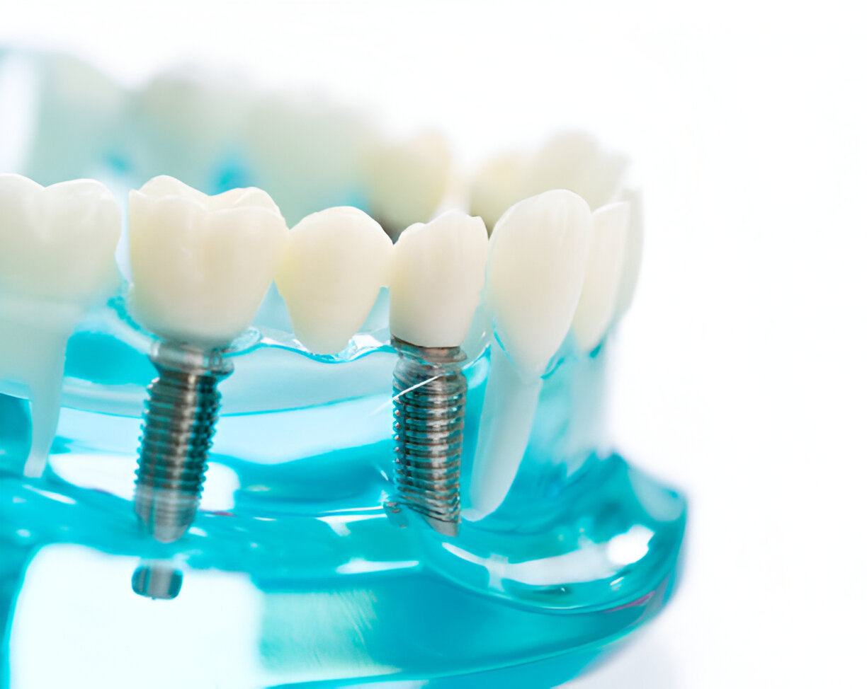 Dental Implants in Kansas City, Missouri: What Makes the Dental Care Center of South Kansas City the Right Choice for You?_3