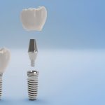 Dental Implants in Kansas City, Missouri: What Makes the Dental Care Center of South Kansas City the Right Choice for You?_FI