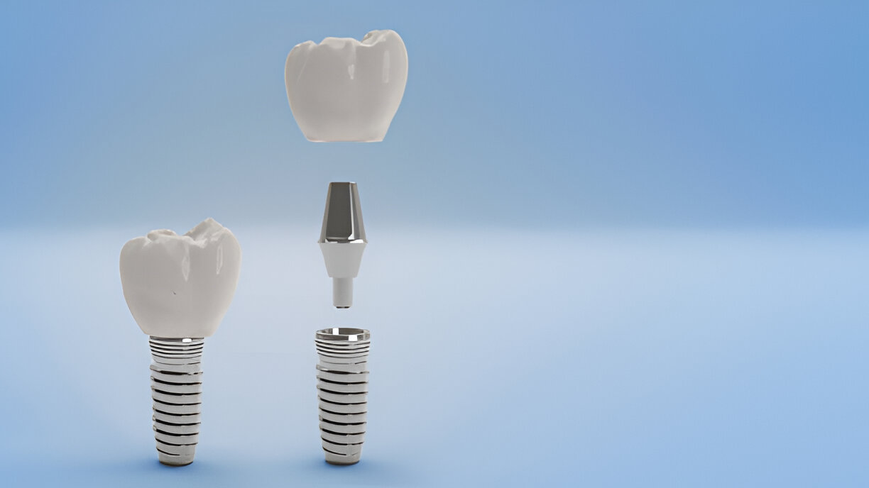 Dental Implants in Kansas City, Missouri: What Makes the Dental Care Center of South Kansas City the Right Choice for You?_FI